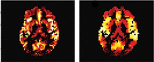 CBF maps before and after applying PVC-mLTS