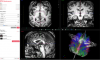 Brainance DTI Module