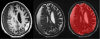 A subject with subdural and subacute epidural hematoma