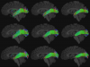 Effect of topographic tract filtering of visual pathway
