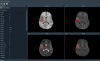 DeepBraTumIA - GUI