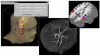 MRIcroGL renderings