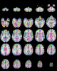 SRI24-TZO cortical/subcortical region map on SPGR channel