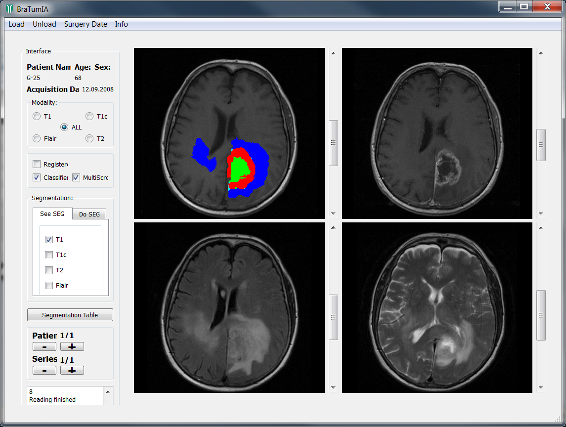 Screenshot of BraTumIA's main interface