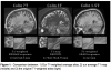 Colin brain atlases
