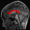 Corpus callosum detected using 'yuki'