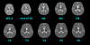 Reconstructe ADC atlases in 10 age groups (axial view).